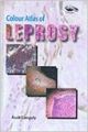 Colour Atlas of Leprosy (English) : Book by Asok Ganguly